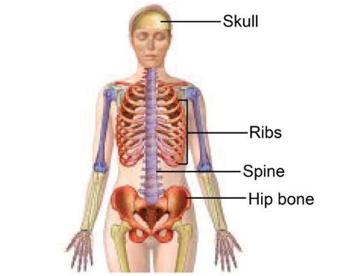 Tulang yang umum terdampak MM.